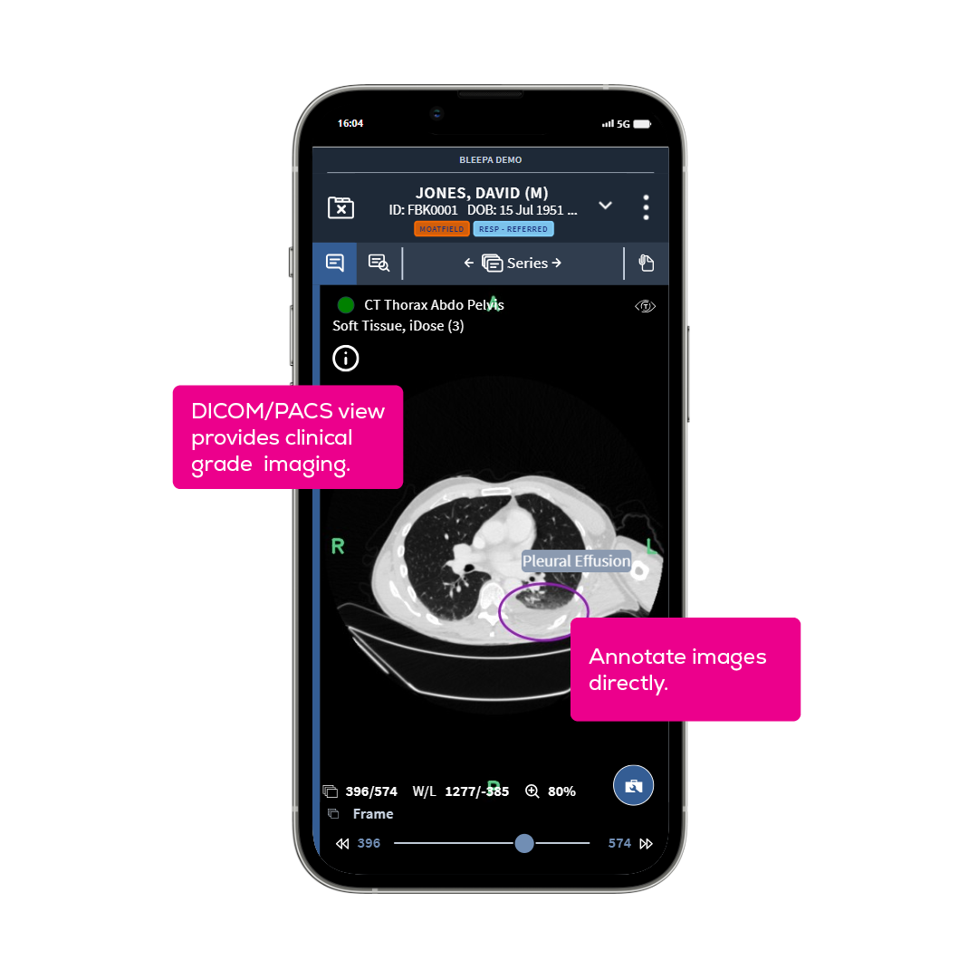 Screenshot of Bleepa mobile view showing CT scan annotated