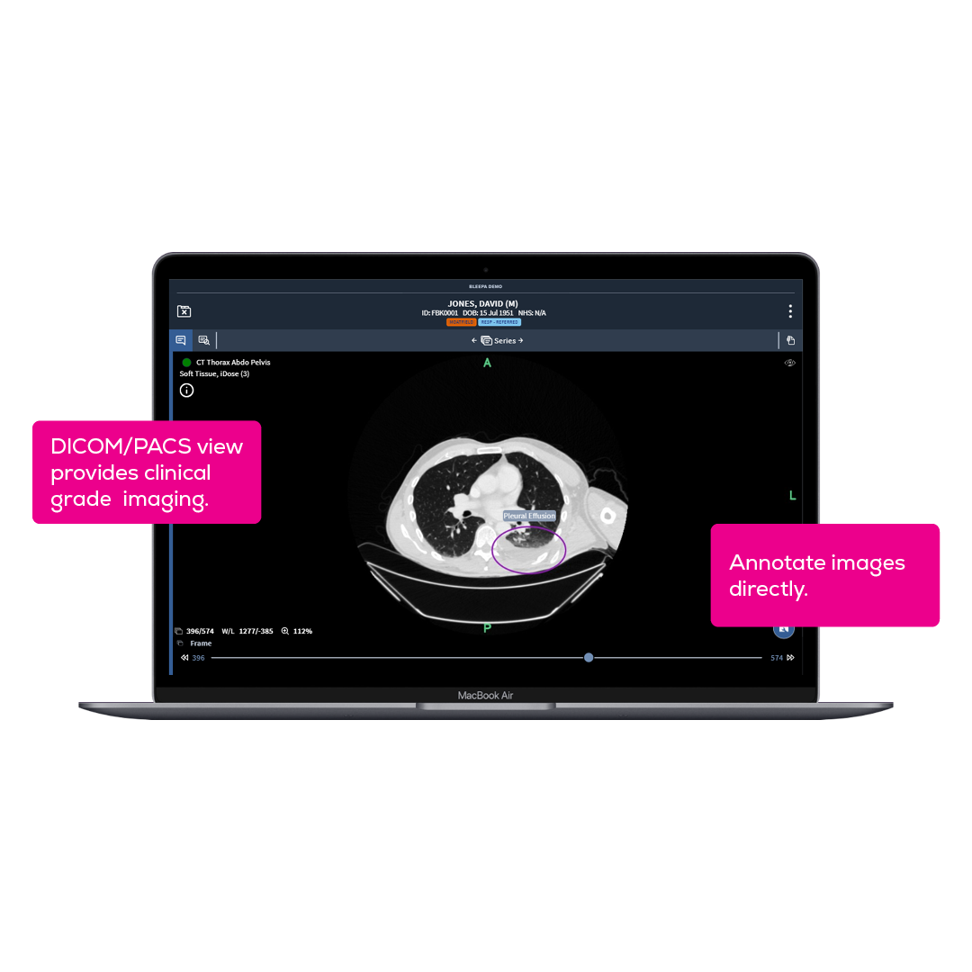 Screenshot of Bleepa desktop showing CT annotated CT scan